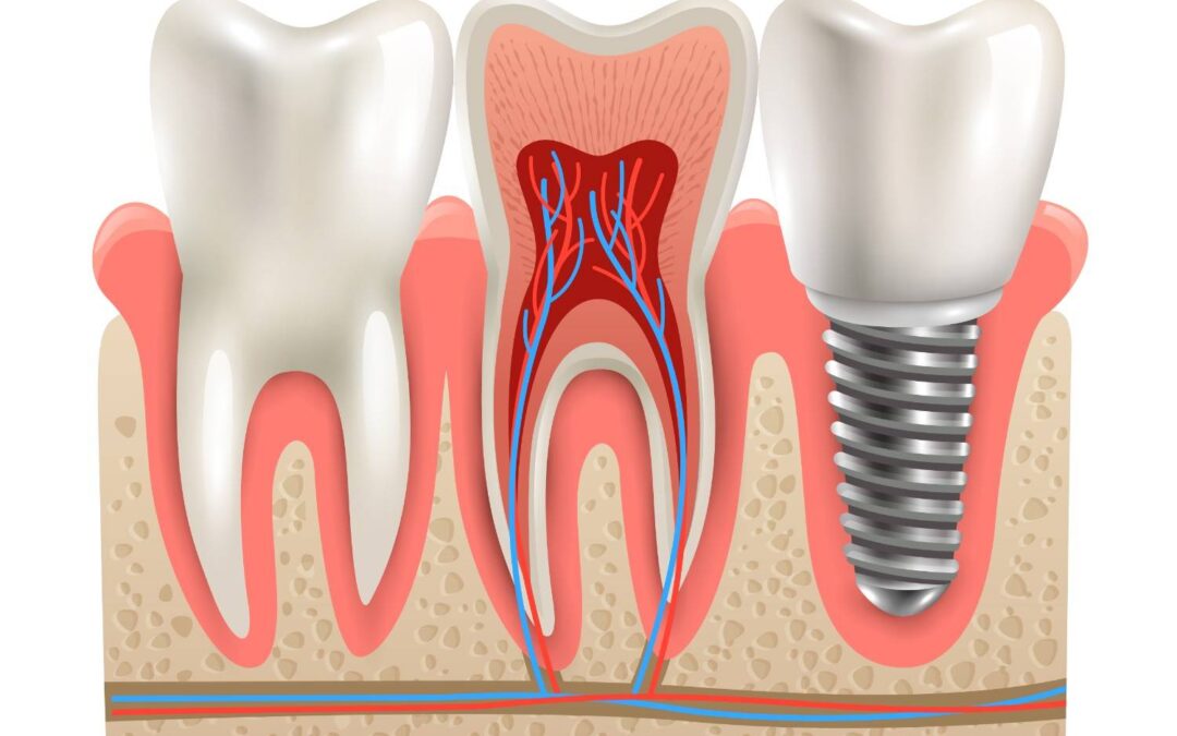 What technology is used for the Best Dental Implants in Siliguri at Dental Retreat?