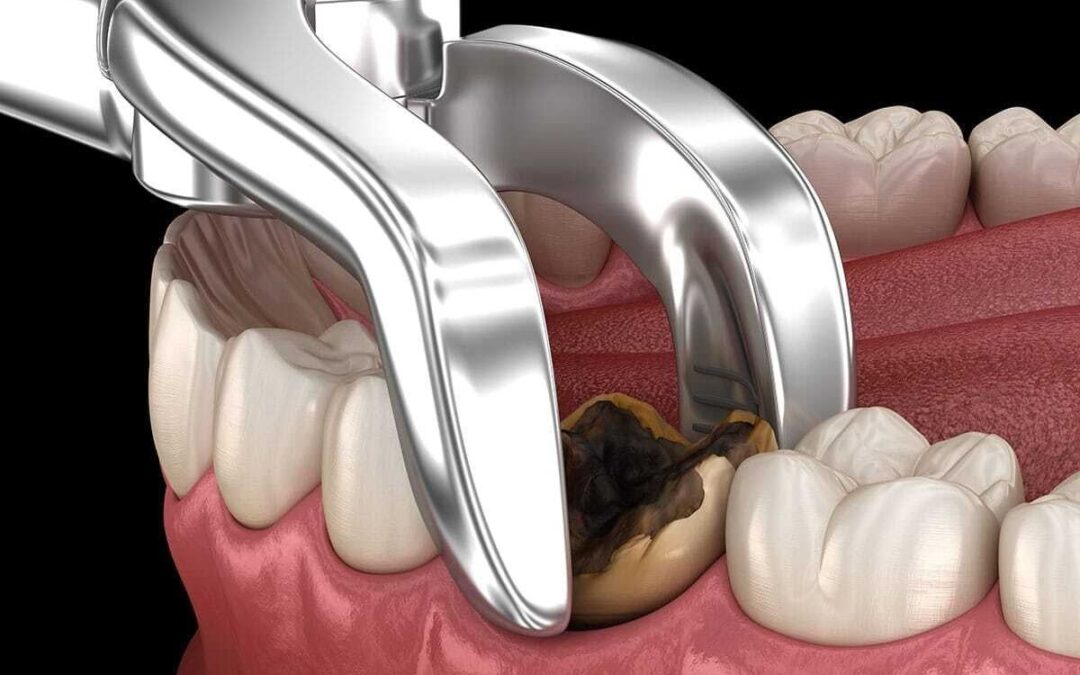How does the Best Dental Extraction in Siliguri at Dental Retreat ensure patient comfort and safety?