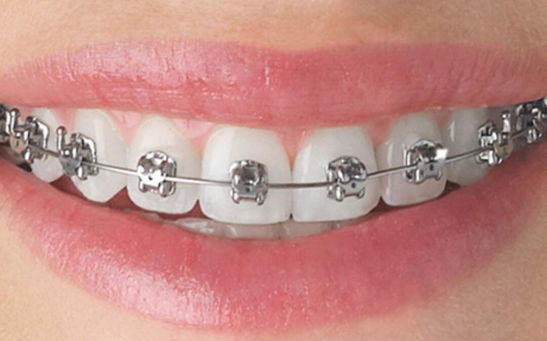 What are the benefits of choosing the Best Orthodontic Treatment in Siliguri for teeth correction?
