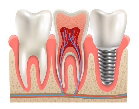 What are the benefits of choosing the Best Dental Implant in Darjeeling over dentures?